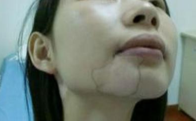 如何在早期即使发现白癜风？如何预防并且治疗白癜风病情？