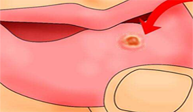 口腔溃疡迟迟不愿意好怎么调理？