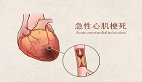 谨防急性心梗 这些知识需掌握