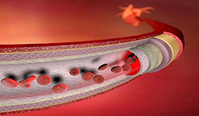 关注您血管中正在悄悄长的“斑”